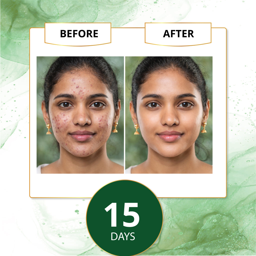 Real skin transformation results after 15 days of using Kuppaimeni gel.